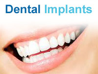 Dental Implants